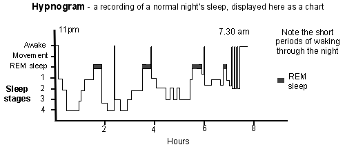 Hypnogram - a chart of a normal night's sleep