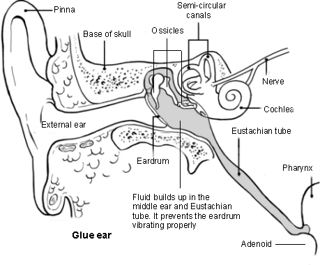 ear diagram and glue ear