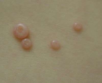 Molluscum contagiosum