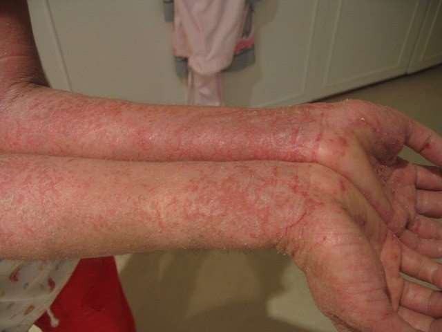 Eczema arms