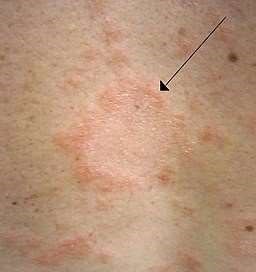 Pityriasis rosea herald