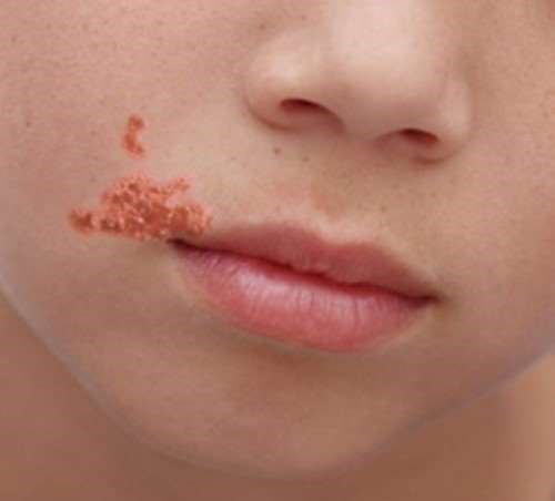 Impetigo close to mouth