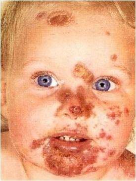 Facial impetigo