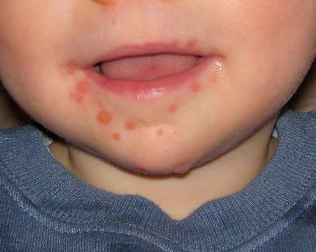 Hand, foot and mouth disease