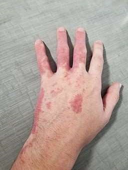 Port-wine stain hand