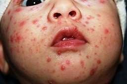 Chickenpox in a child