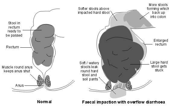 Chronic constipation