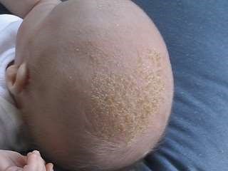 Cradle cap