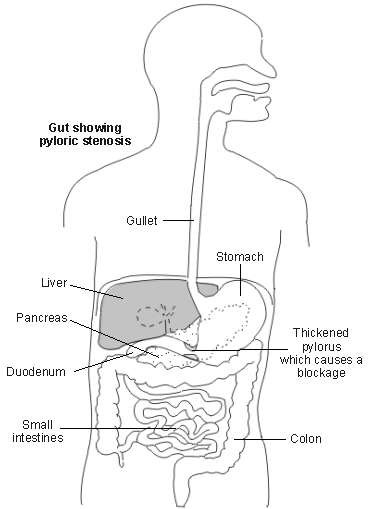 pyloric stenosis